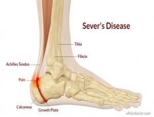 Heel Pain with Sever's Disease