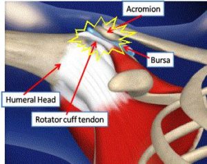 Shoulder Impingement