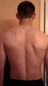 Winging scapula