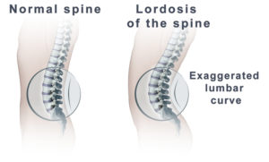 Excessive Lordosis