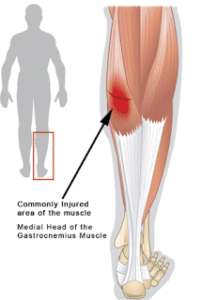 Gastrocnemius Tear