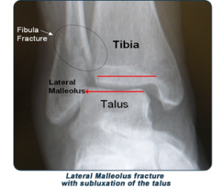 ankle-fracture